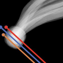 Electric field sensors for ESA’s Comet Interceptor mission 